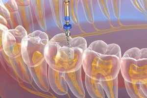 Endodontics